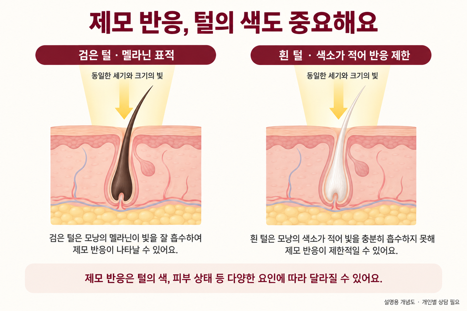 검은 털과 흰 털의 멜라닌 양 차이에 따라 레이저제모 반응에 한계가 있음을 보여주는 개념도