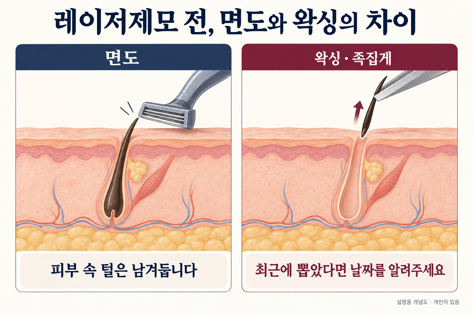 면도는 피부 속 털을 남기고 왁싱은 털을 뽑지만 모낭 조직은 남는 차이를 보여주는 개념도