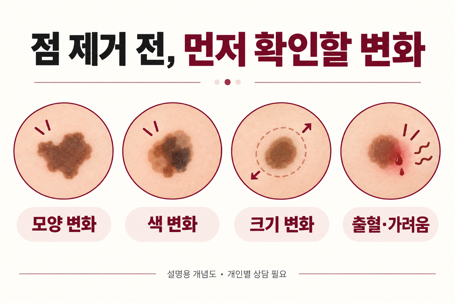 점 제거 전에 모양과 색, 크기의 변화 및 출혈과 가려움을 확인하는 설명용 그림