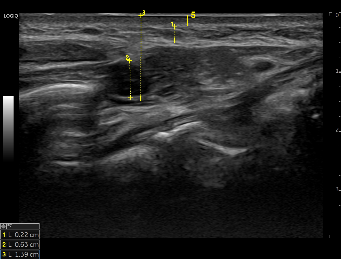 피부와 피하 조직을 관찰한 초음파 화면